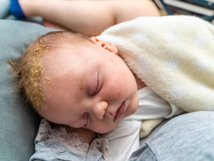 Cradle Cap