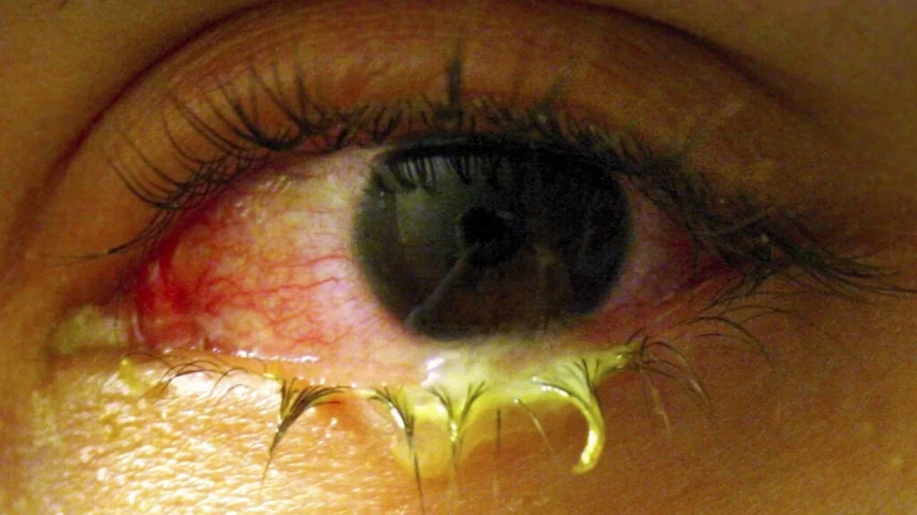 Conjunctivitis