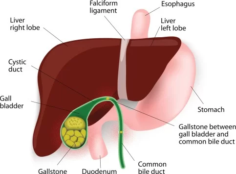 Cholelithiasis Cholelithiasis