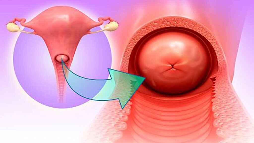 CERVICITIS