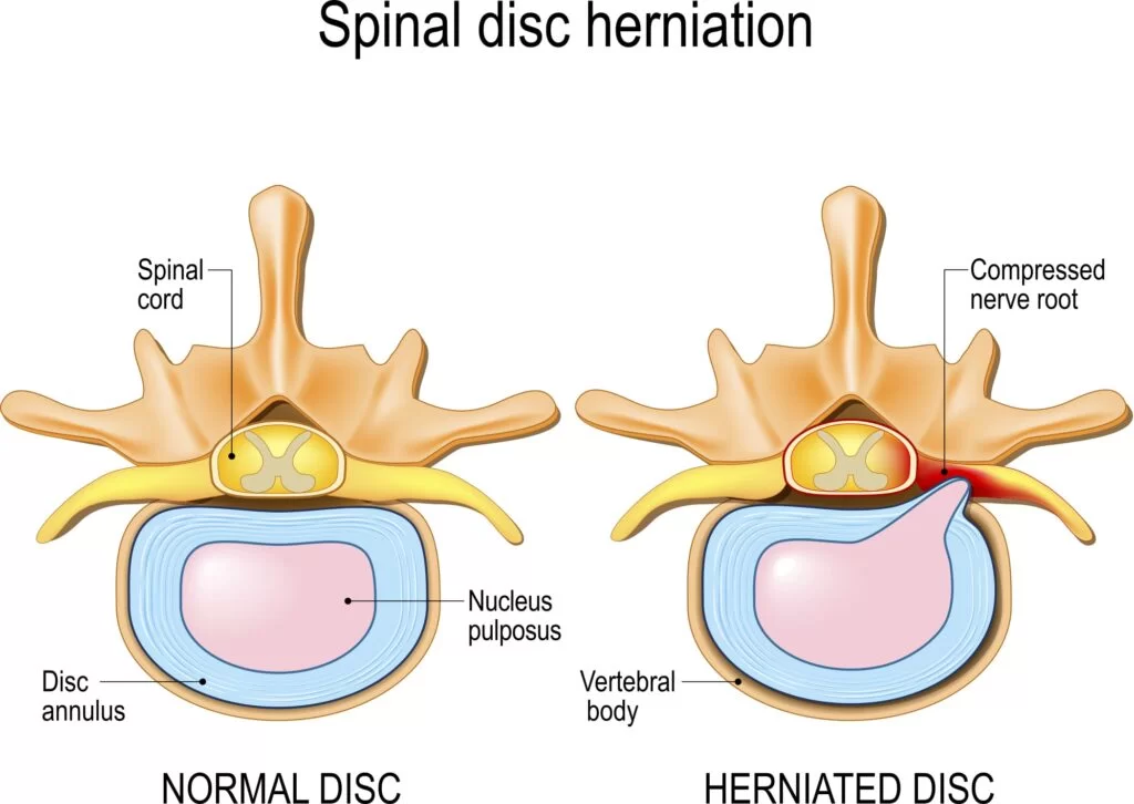 Disc Prolapse