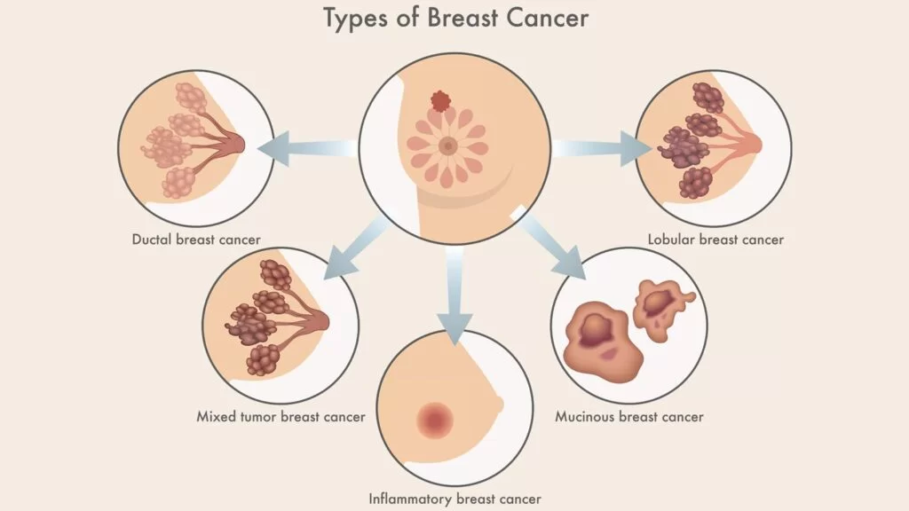 Breast Cancer
