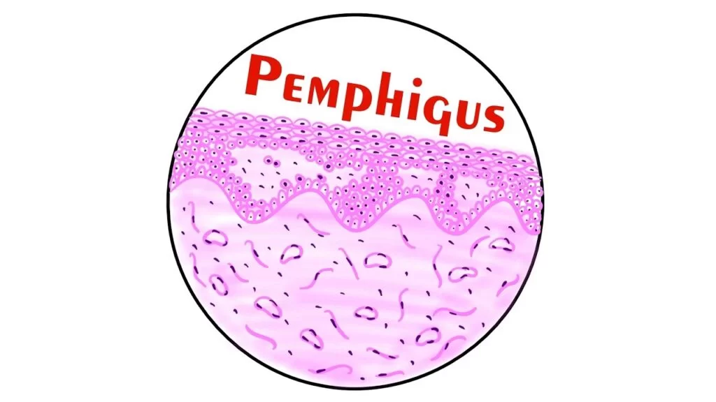 Pemphigoid