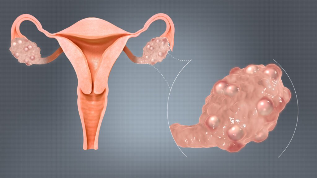 POLYCYSTIC OVARIAN DISEASE