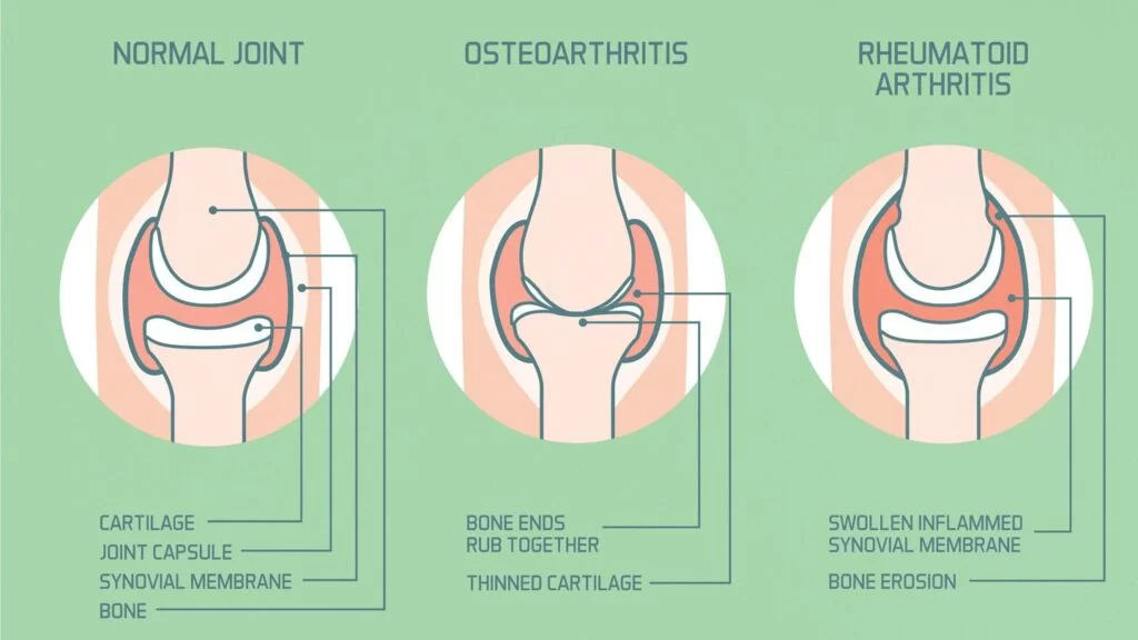Rheumatoid Arthritis