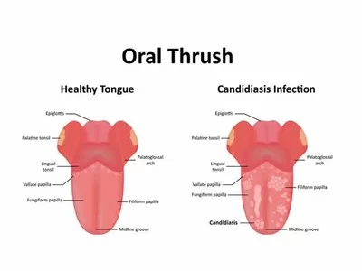 Thrush