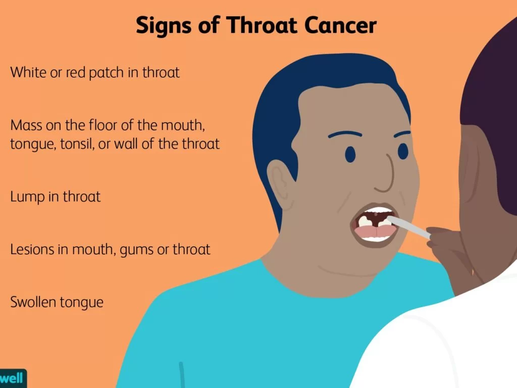 Throat Cancer