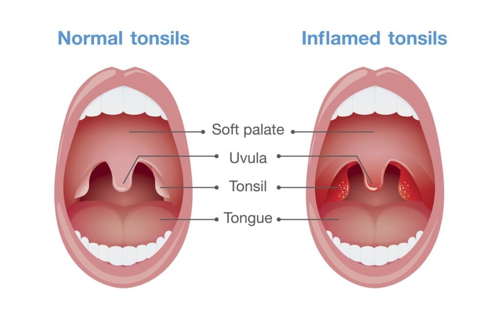 Tonsil Surgery