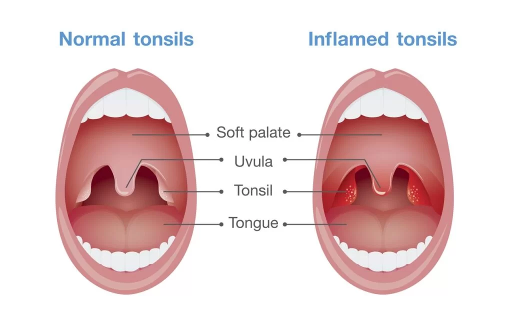 Tonsil Surgery