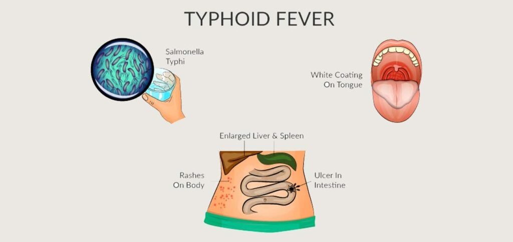 Typhoid