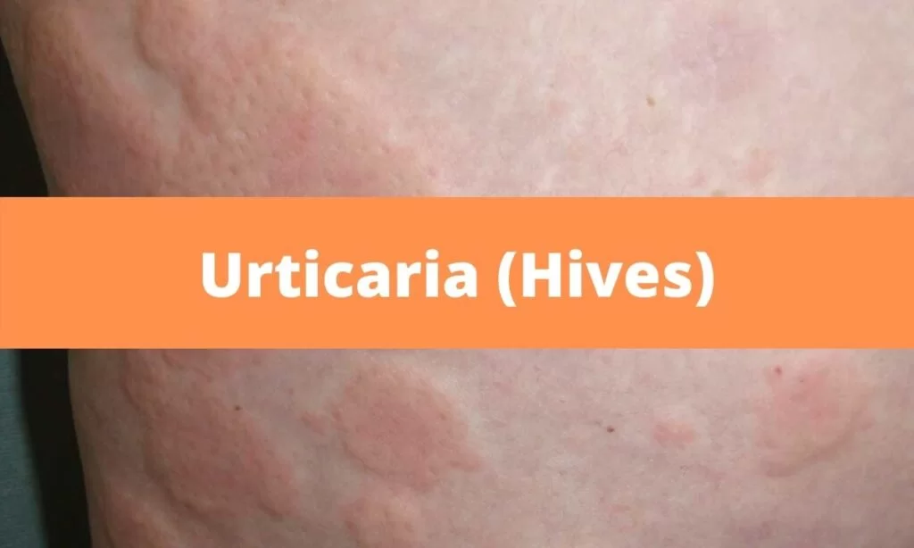 Urticaria