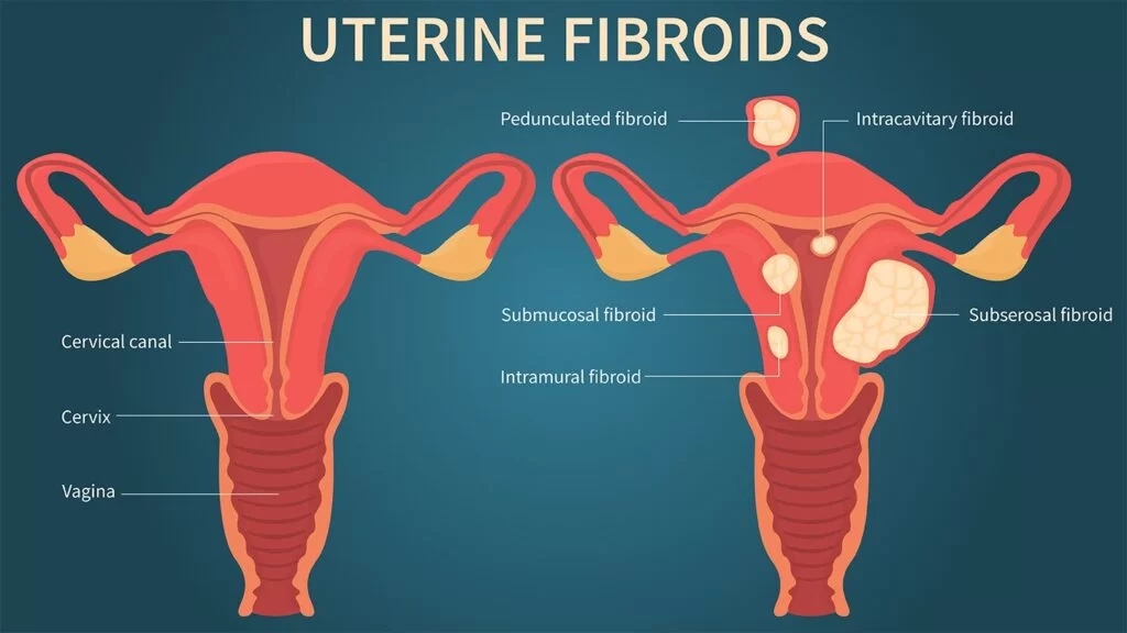 Uterine Fibroid