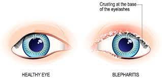 Blepharitis