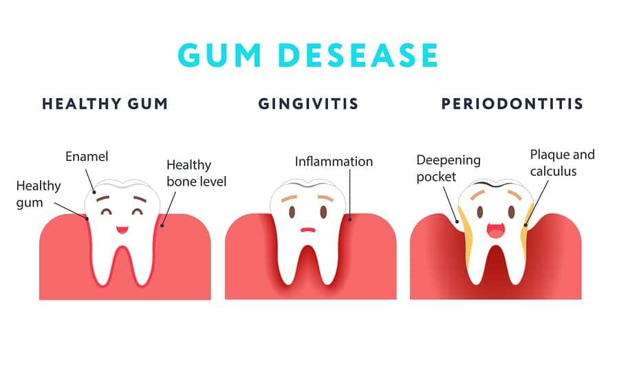 Bleeding Gums Or Gingivitis