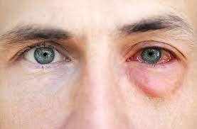Allergy eye