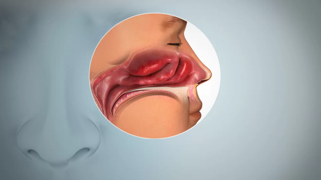 Anosmia Anosmia