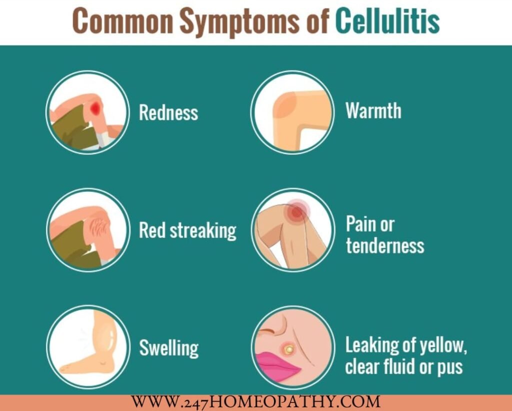 CELLULITIS