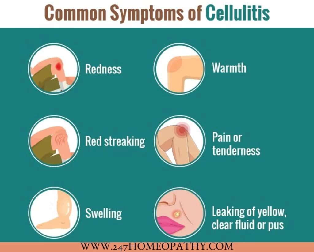 CELLULITIS