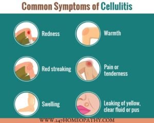 Cellulitis symptoms