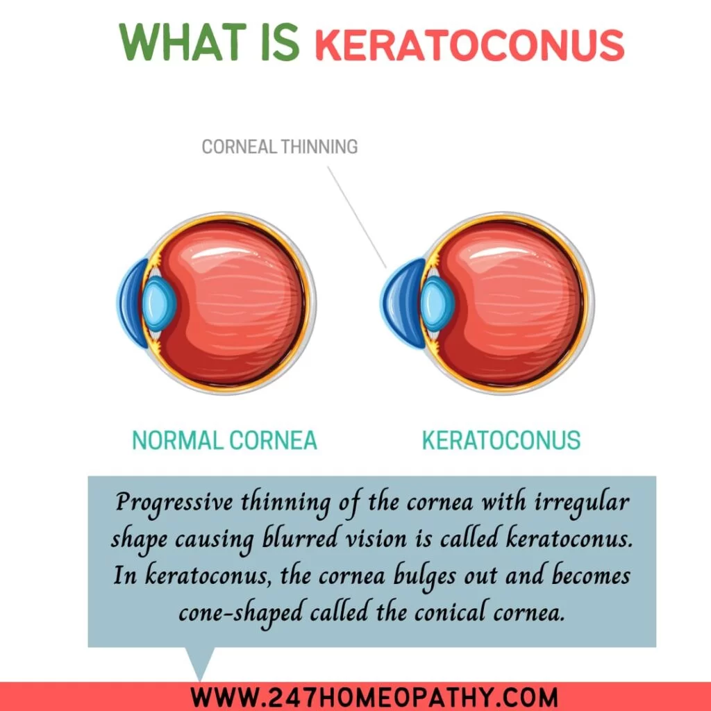 Keratoconus