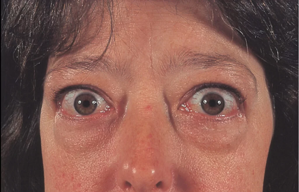 Graves Disease