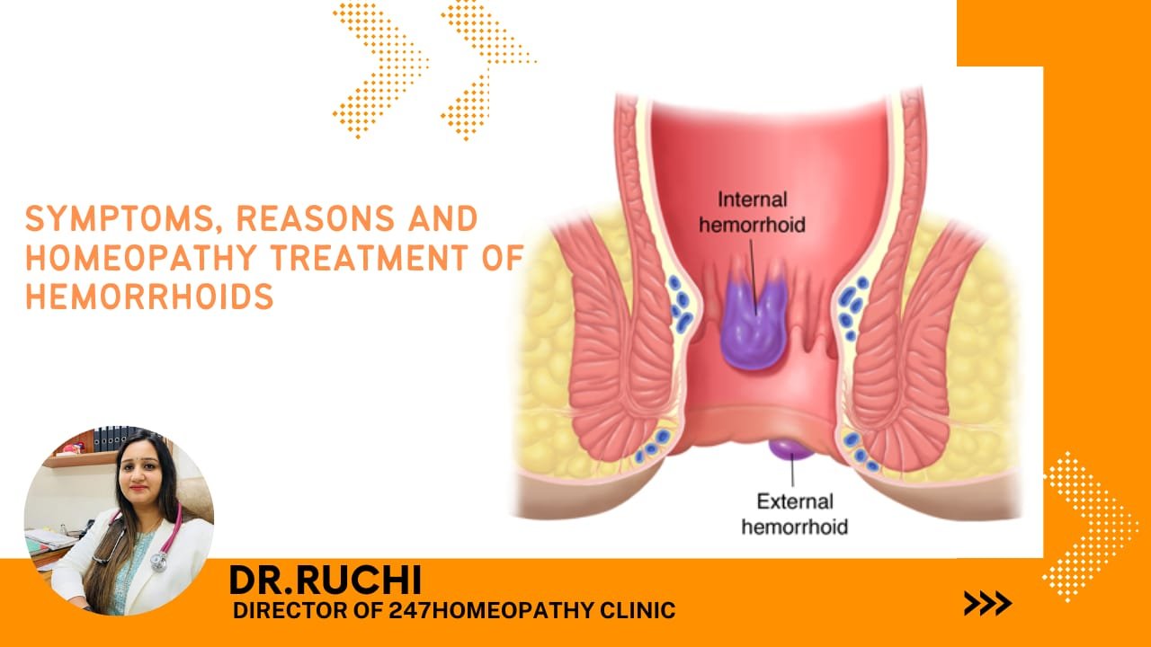 Know how to shrink haemorrhoids with homoeopathy. Hemorrhoid Symptoms, Reasons and Hemorrhoid Homeopathy Treatment in Hindi by Dr Ruchi.