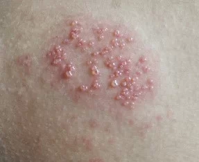 Genital Herpes