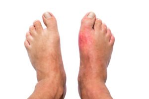 Homeopathy medicines for Gout