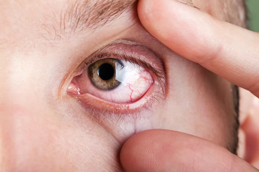 Eye Dryness