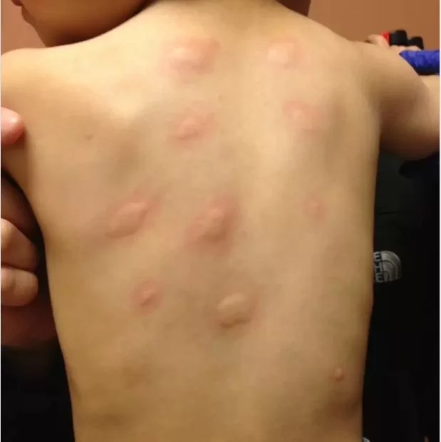 Egg Allergy