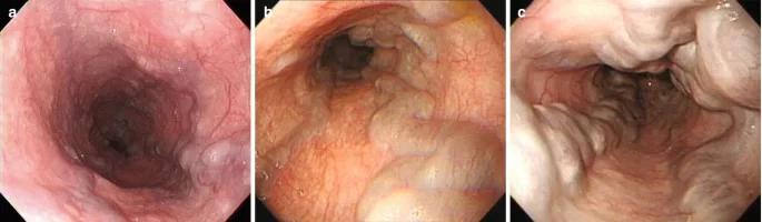 Esophageal Varices