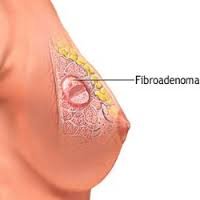 Fibroadenoma of the Breast