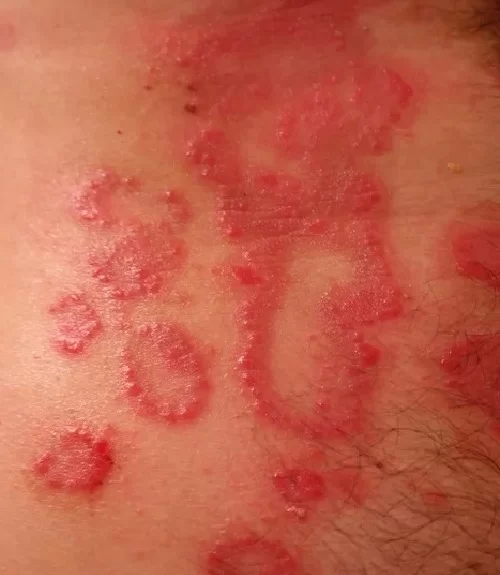 Eczema Eczema