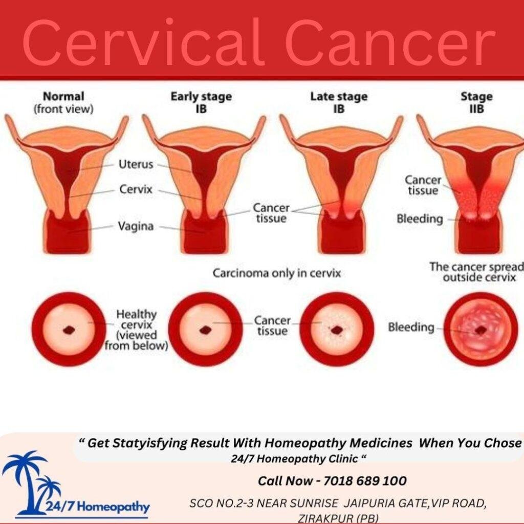 CERVICAL CANCER HOMOEOPATHIC TREATMENT