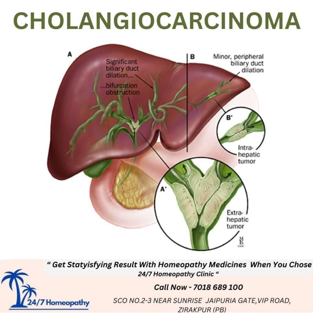 CHOLANGIOCARCINOMA (BILE DUCT CANCER) homeopathy treatment