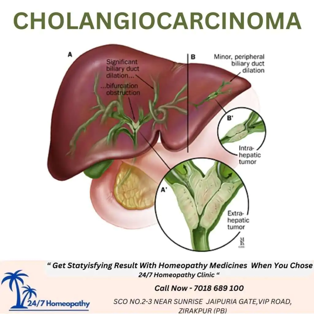 CHOLANGIOCARCINOMA (BILE DUCT CANCER) homeopathy treatment