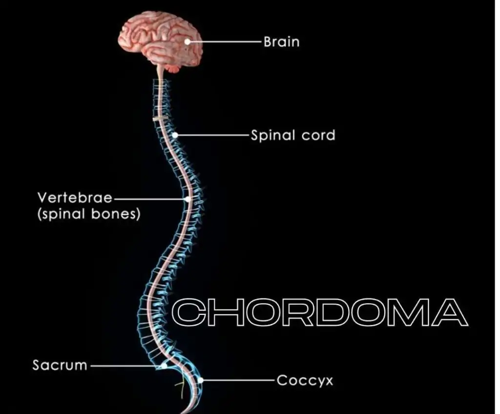 CHORDOMAS HOMOEOPATHY TREATMENT zirakpur
