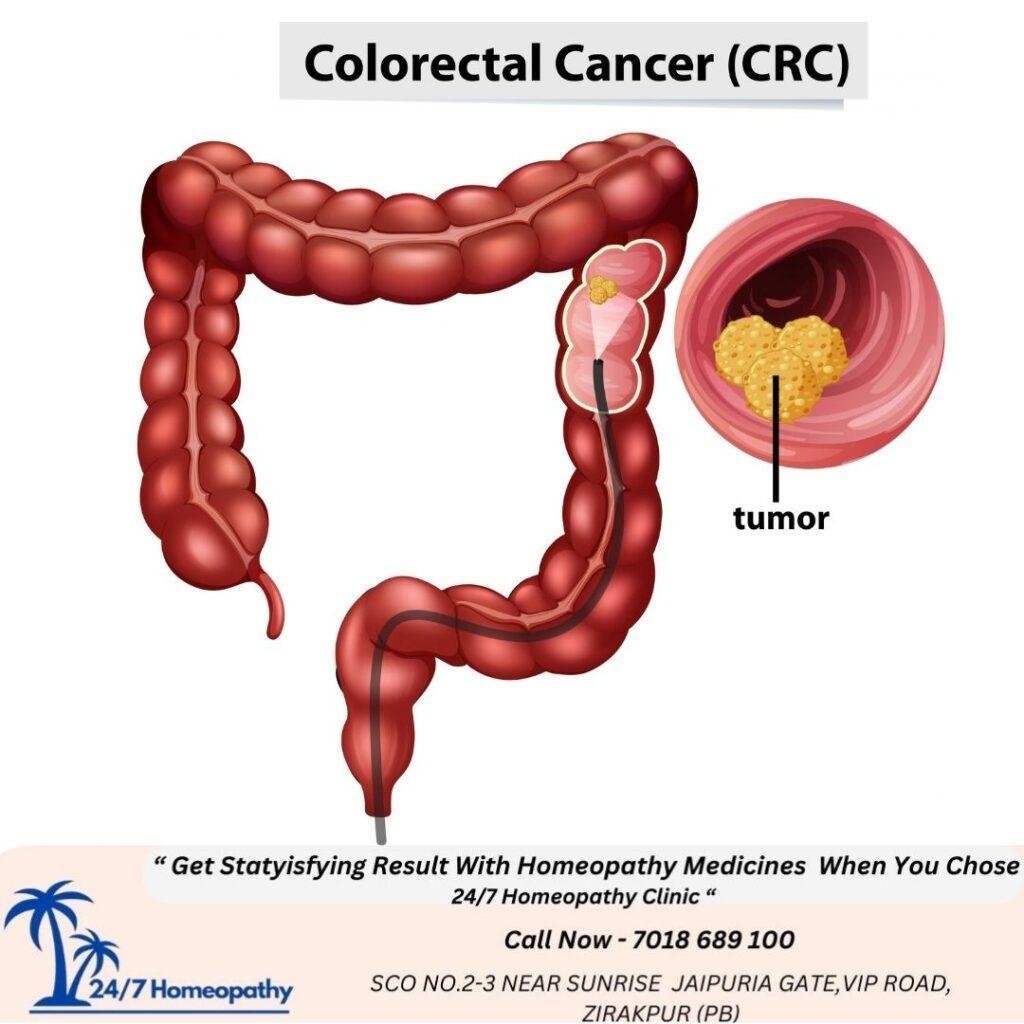 COLORECTAL CANCER HOMOEOPATHY TREATMENT ZIRAKPUR