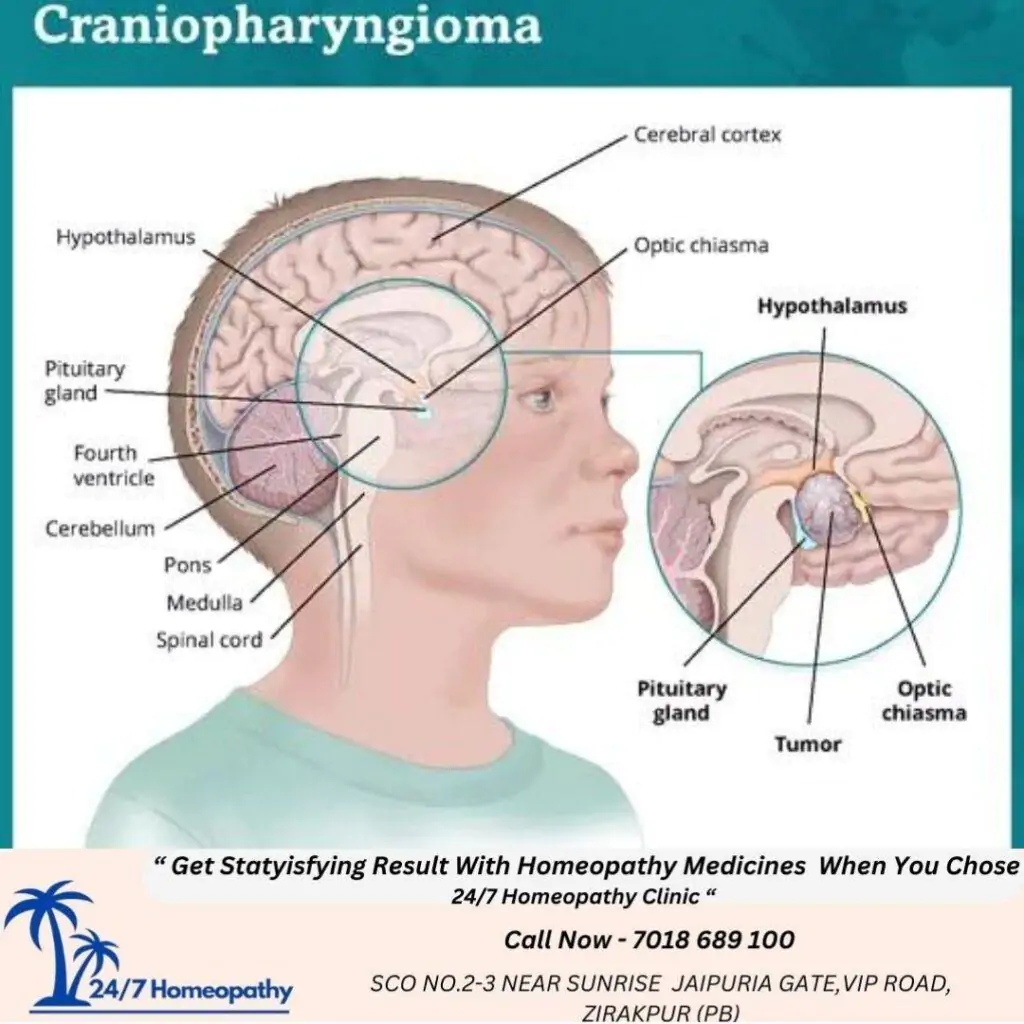CRANIAPHARYNGIOMA HOMEOPATHY TREATMENT IN Zirakpur