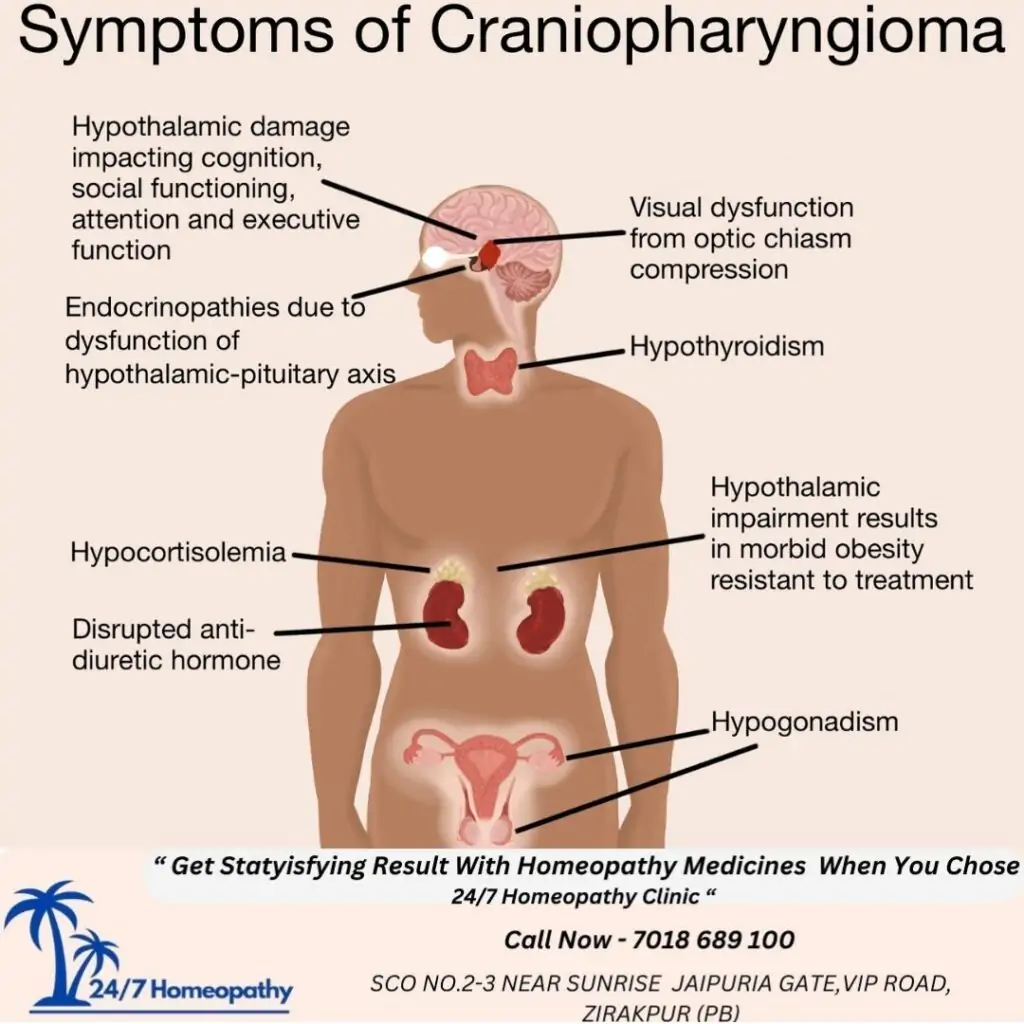 CRANIAPHARYNGIOMA symptoms and HOMEOPATHY TREATMENT IN Zirakpur
