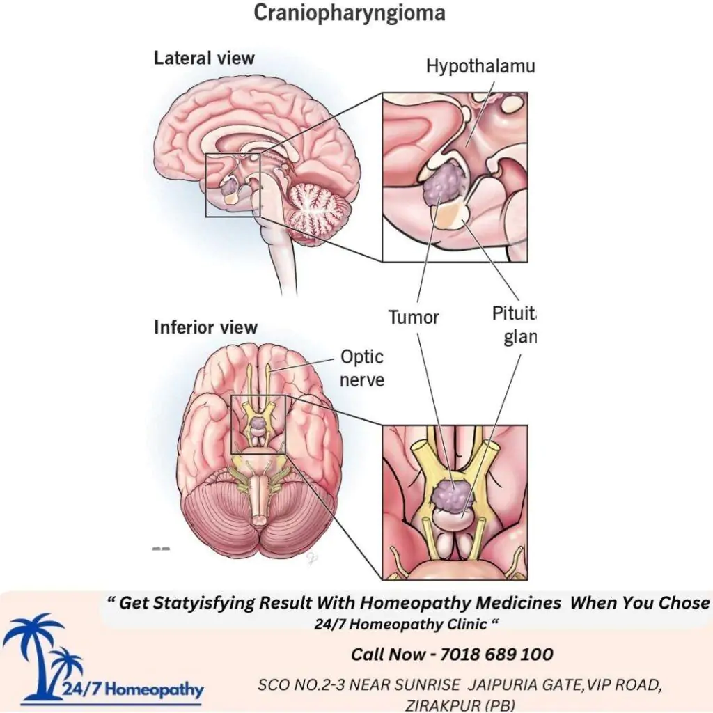 CRANIAPHARYNGIOMA HOMEOPATHY TREATMENT IN Zirakpur