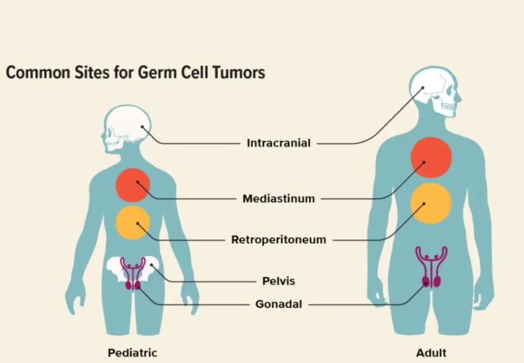 EXTRA GONADAL GERM CELL TUMOUR TREATMENT BY HOMEOPATHY MEDICINE
