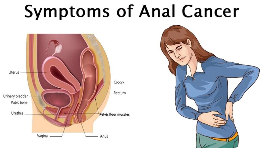 ANAL CANCER symptom and HOMOEOPATHIC TREATMENT: