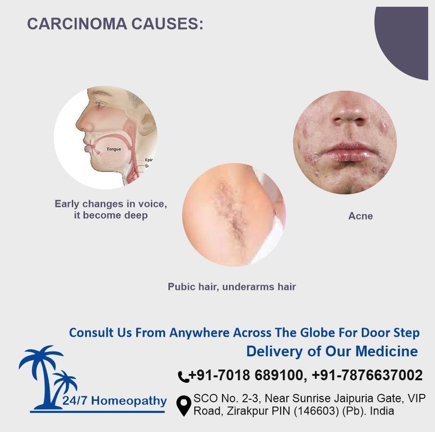 Adrenocortical carcinoma CAUSES AND HOMEOPATHY TREATMENT IN ZIRAKPUR