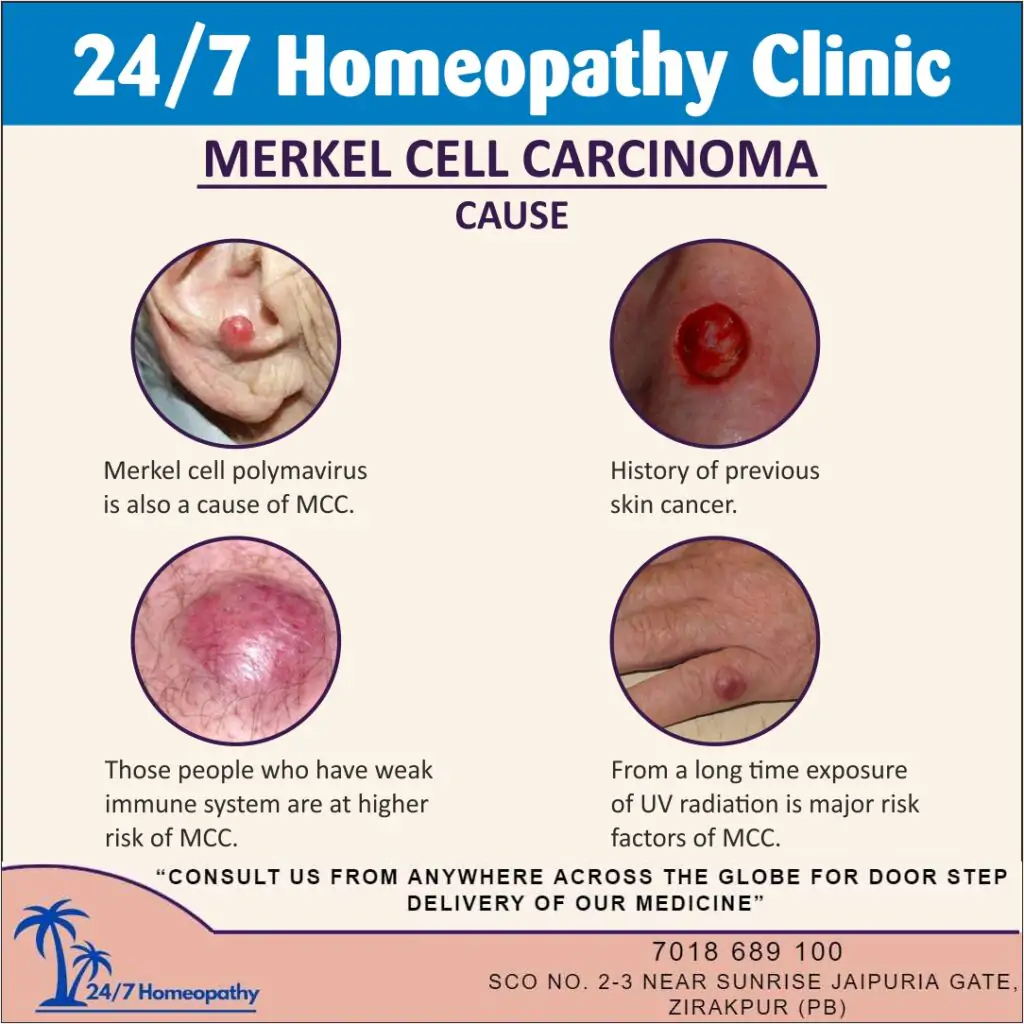 Merkel Cell HOMEOPATHY TREATMENT IN Zirakpur