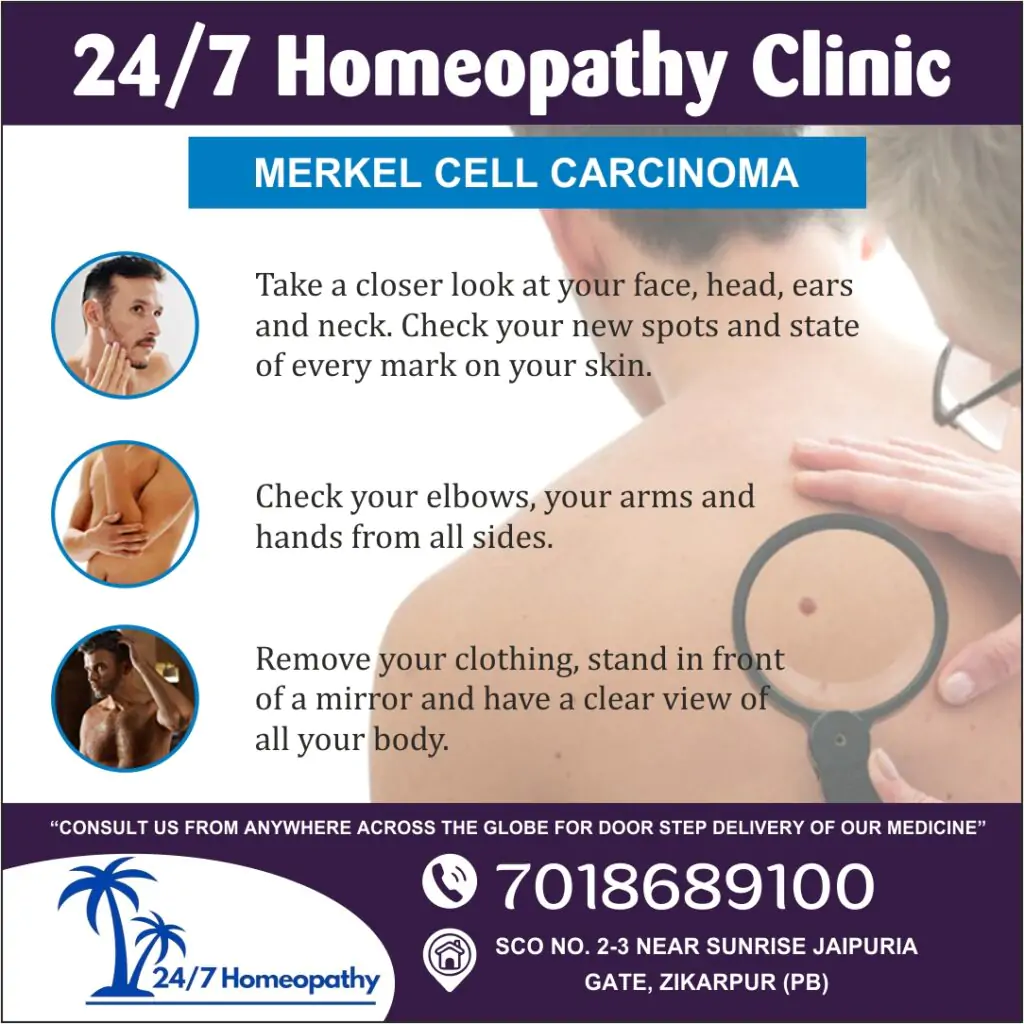 Merkel Cell HOMEOPATHY TREATMENT IN Zirakpur