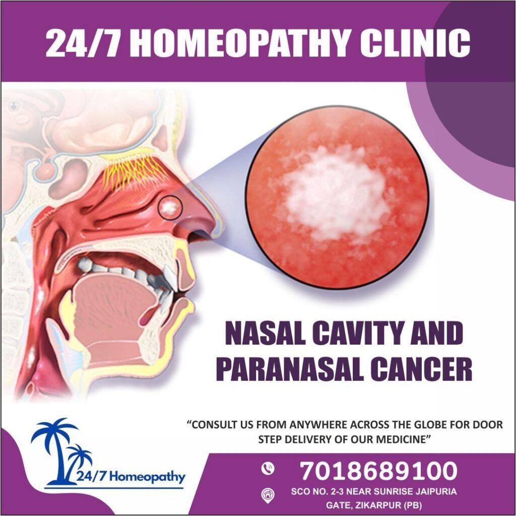 Nasal Cavity And Paranasal Cancer 247homeopathy 4254