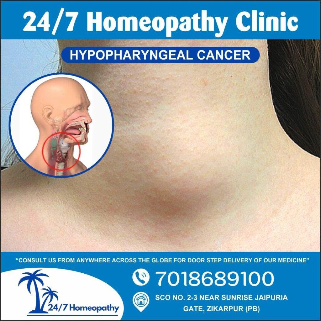 HYPOPHARYNGEAL  homeopathy treatment zirakpur
