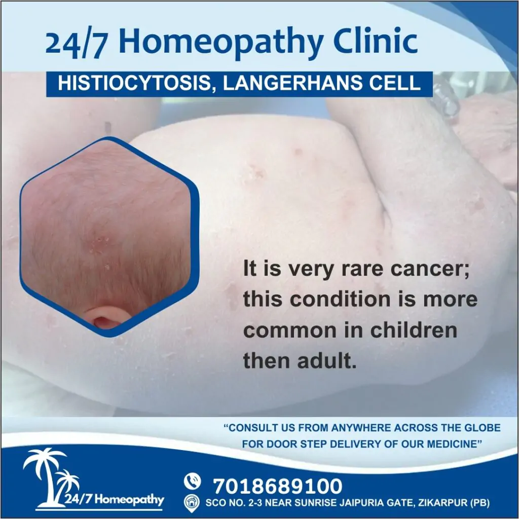 HISTIOCYTOSIS/ LANGERHANS CELL homeopathy treatment zirakpur