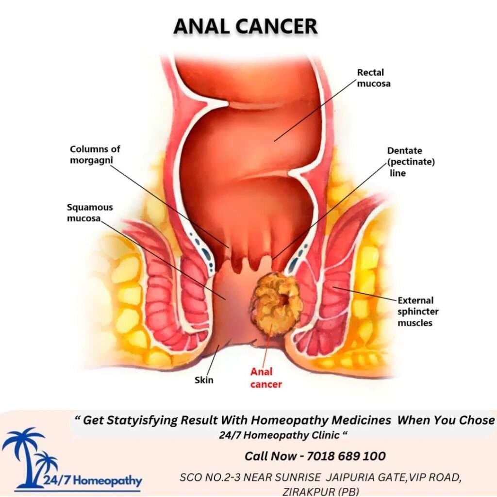 ANAL CANCER HOMOEOPATHIC TREATMENT: